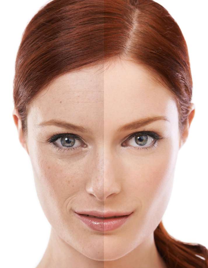 aging spots treatment