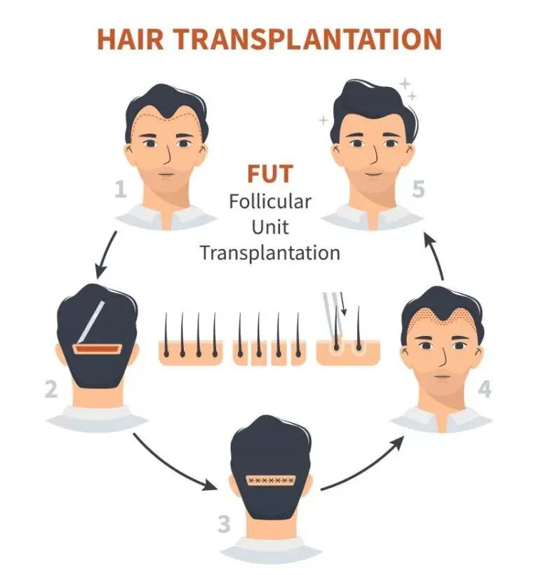 fut hair transplant near me